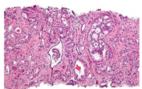 化合物有望成为下一代前列腺癌疗法
