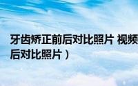 牙齿矫正前后对比照片 视频（2024年07月26日牙齿矫正前后对比照片）