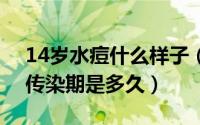 14岁水痘什么样子（2024年09月07日水痘传染期是多久）