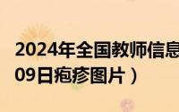 2024年全国教师信息管理系统（2024年09月09日疱疹图片）