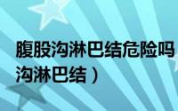 腹股沟淋巴结危险吗（2024年09月12日腹股沟淋巴结）