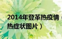 2014年登革热疫情（2024年09月18日登革热症状图片）